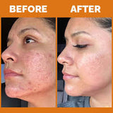 Teashell Niacinamide Brightening Serum |BUY ONE GET ONE FREE/ Fades Dark Spots, Evens Skin Tone & Boosts Glow (Buy 1 Get 1 Free)