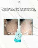 Face IT Anti Acne Serum Buy 1 Get 1 Free