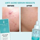 Face IT Anti Acne Serum Buy 1 Get 1 Free