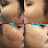 Teashell Niacinamide Brightening Serum |BUY ONE GET ONE FREE/ Fades Dark Spots, Evens Skin Tone & Boosts Glow (Buy 1 Get 1 Free)